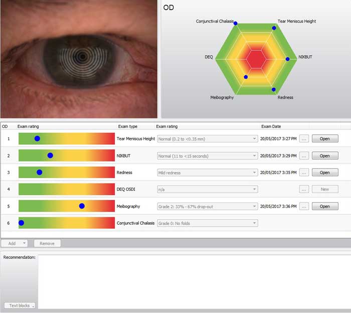 Regular Diabetic Eye Exams Prevent Vision Loss