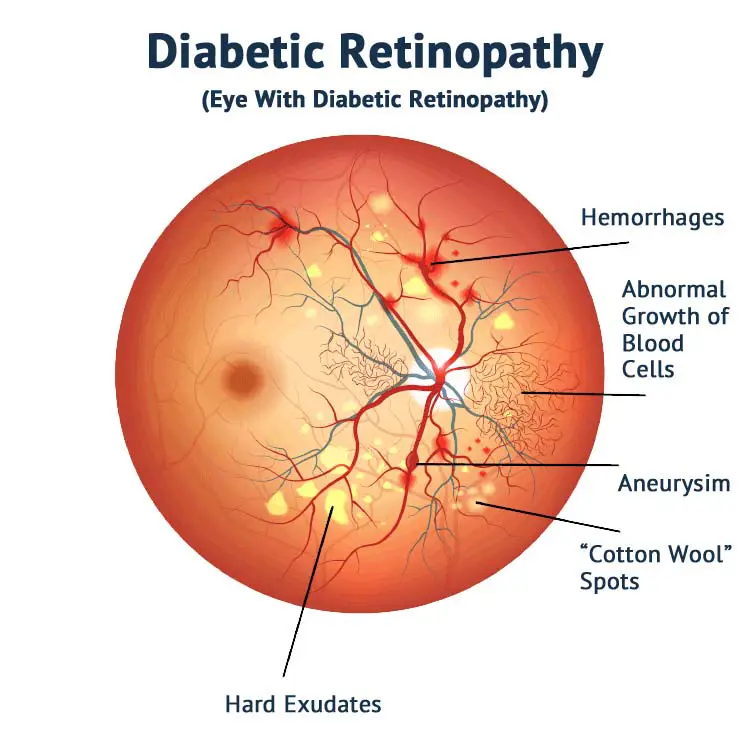 Eye With Diabetic Retinopathy