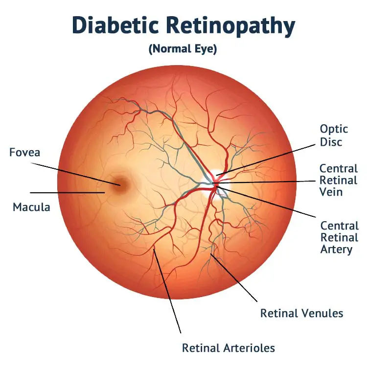 Healthy Eye Before Diabetic Retinopathy