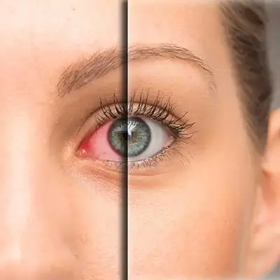 Dry Eye Treatment Dry Eye Treatment