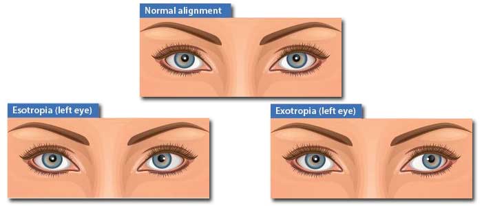 Eye Exams: Eye Alignment - assessing for strabismus