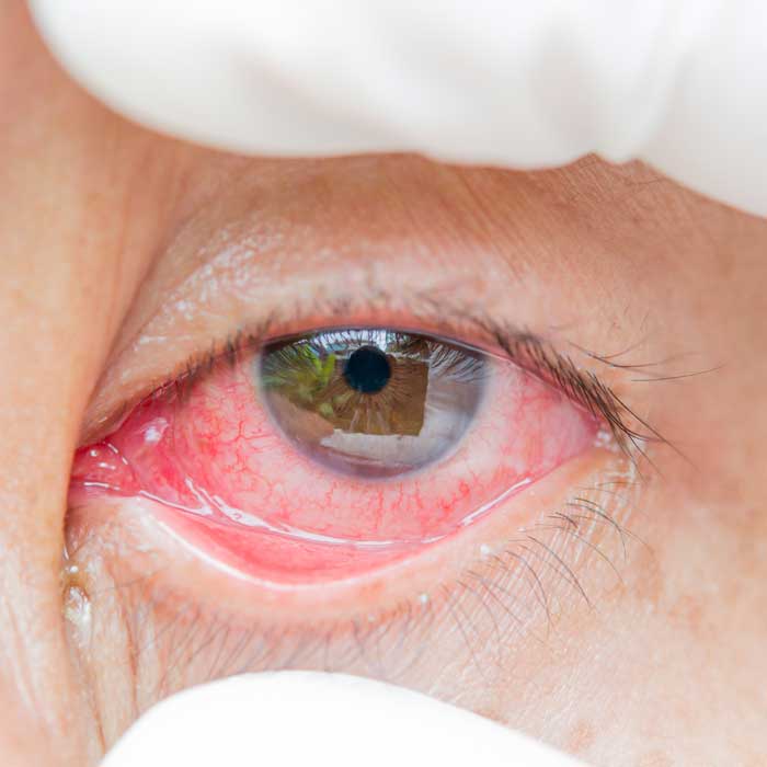 Eye Emergency - Eye Infection