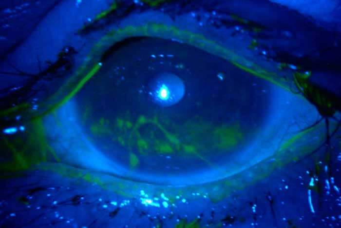 Contact Lens Exam: Fluorescein Stain Test