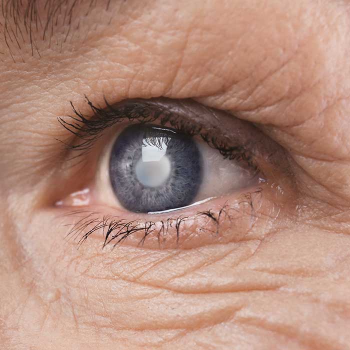 Eye Disease: Glaucoma