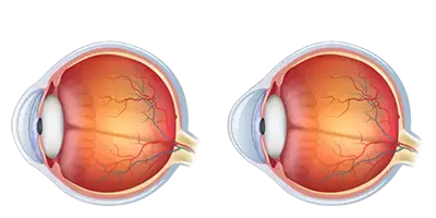 Scleral Contact Lenses Diagram Scleral Contact Lenses Diagram