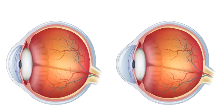 Normal Eye vs. Eye With Keratoconus