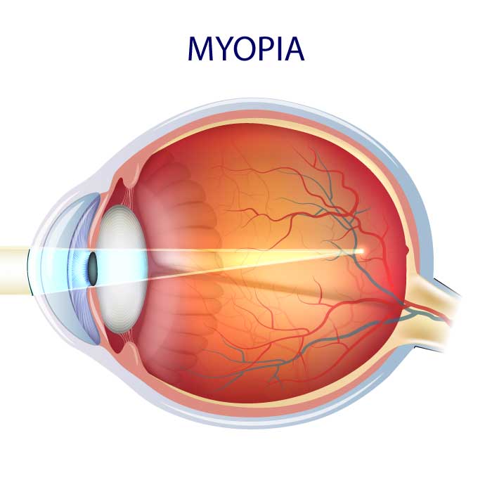 Myopia - Nearisghtedness