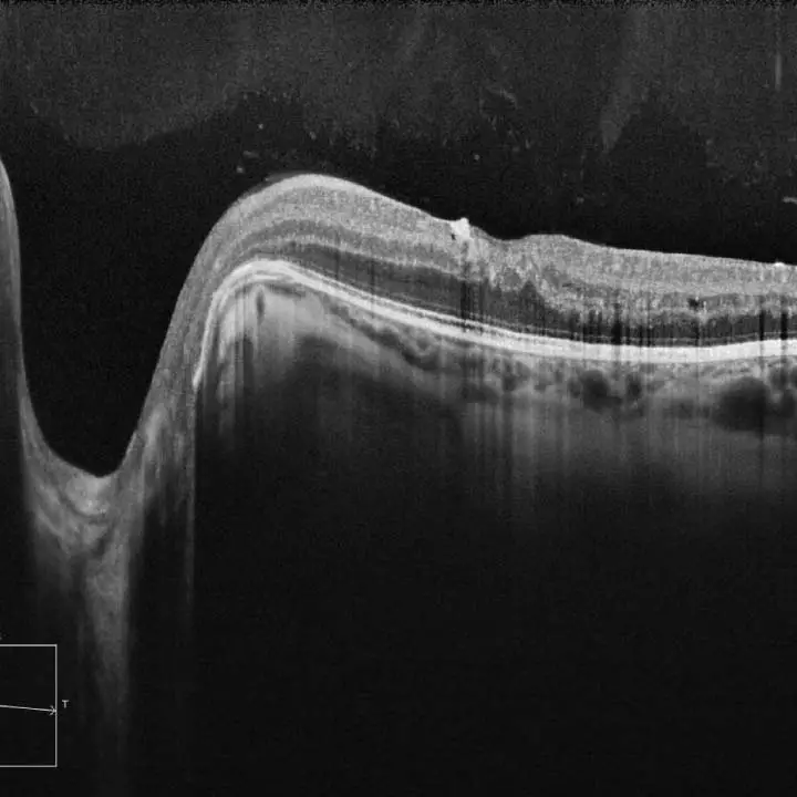 Optical Coherence Tomography Eye Exam in Edmonton Optical Coherence Tomography Eye Exam in Edmonton