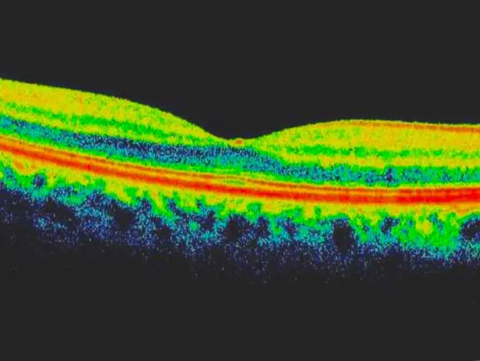 Optical Coherence Tomography Test Optical Coherence Tomography Test