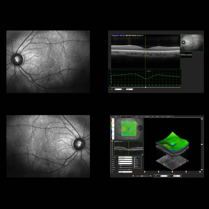 OCT Imaging Results OCT Imaging Results