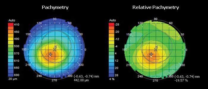 Eye Exams: Pachymetry - measuring corenal thickness