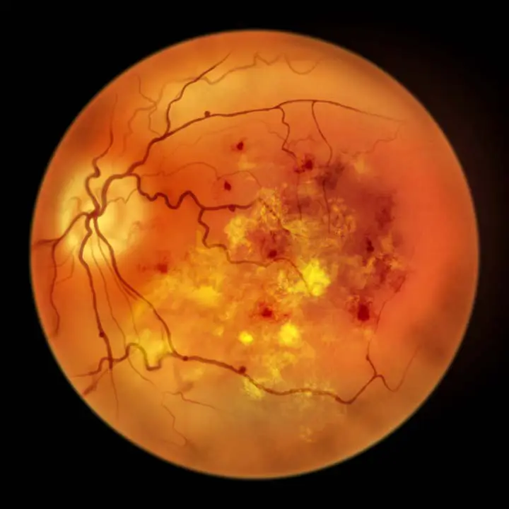 Wide Angle Retinal Photography in Edmonton