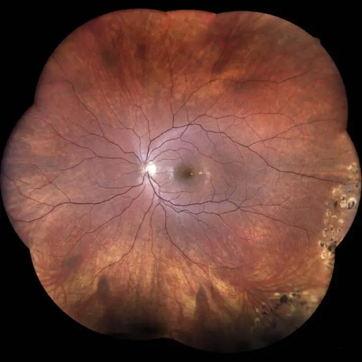 Wide Angle Retinal Photography Showing Laser Treatment