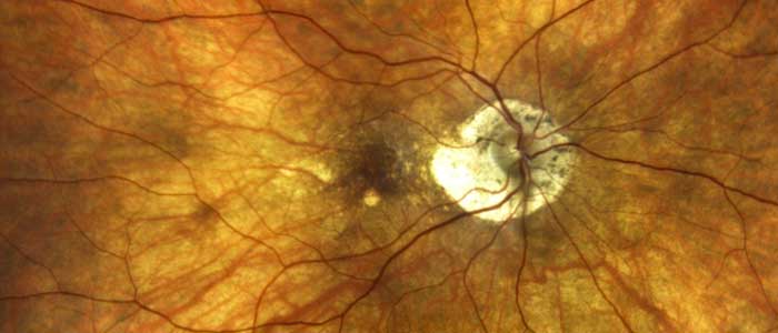 Eye Exams: Retinal Imaging - a detailed snapshot of the retina