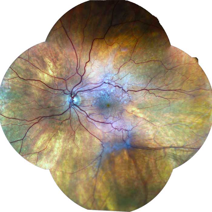 Advanced Eye Doctor Diagnostic Technologies - Wide-Angle Retinal Photography