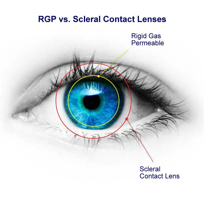 Scleral Contact Lenses vs. Rigid Gas Permeable Contact Lenses