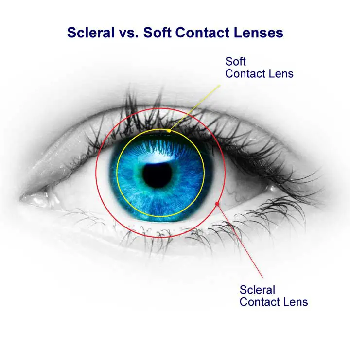 Scleral Contact Lenses vs. Soft Contact Lenses