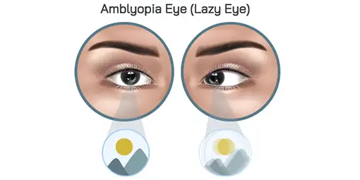 Amblyopia (Lazy Eye) - Symptoms, Causes and Treatment