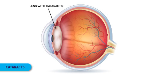 Cataracts - Symptoms, Causes and Treatment