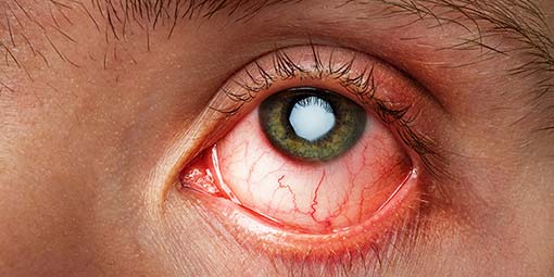There Are Many Causes Of Itchy Eyes