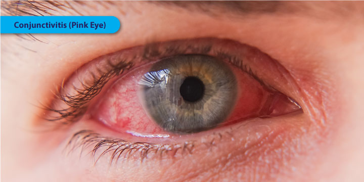 Conjunctivitis (Pink Eye) - Symptoms, Causes and Treatment