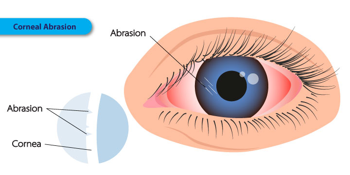 Corneal Abrasion - Symptoms, Causes and Treatment