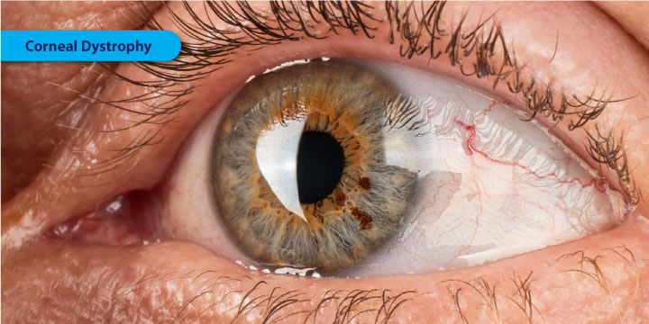 Corneal Dystrophy - Symptoms, Causes and Treatment
