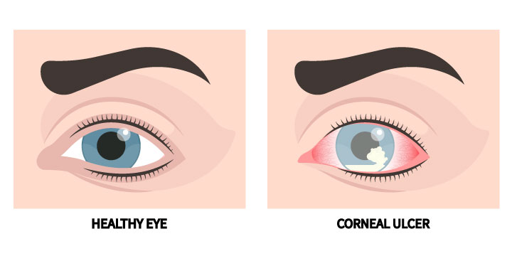 Corneal Ulcer - Symptoms, Causes and Treatment