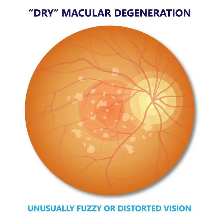 Dry Macular Degeneration