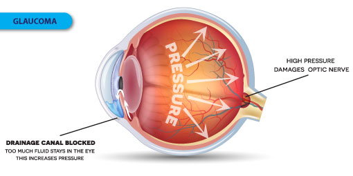 Glaucoma - Symptoms, Causes and Treatment