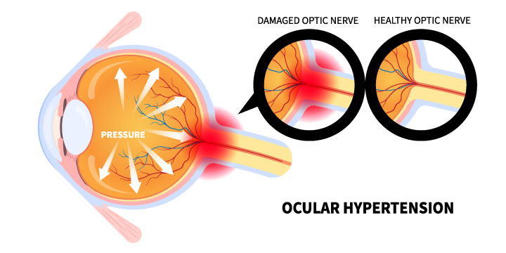 Ocular Hypertension - Symptoms, Causes and Treatment