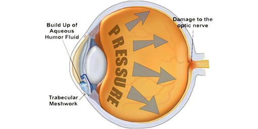 Ocular Hypertension or intraocular pressure (IOP)