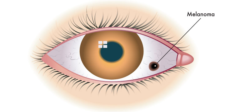 Ocular Melanoma - Symptoms, Causes and Treatment