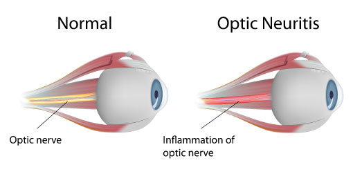 Optic Neuritis - Symptoms, Causes and Treatment