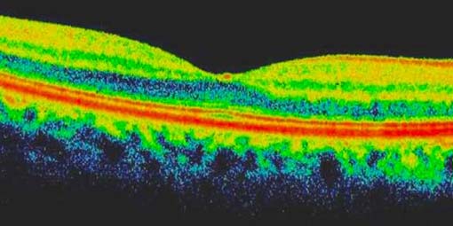 Optical Coherence Tomography (OCT) is like an ultrasound of the eye using white light.
