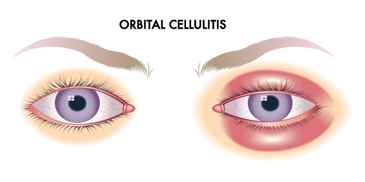 Orbital Cellulitis - Symptoms, Causes and Treatment