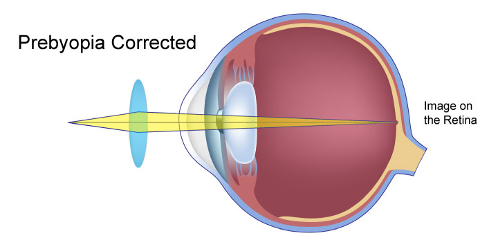 Presbyopia Correct in Edmonton