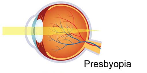 Presbyopia affects everyone as they age