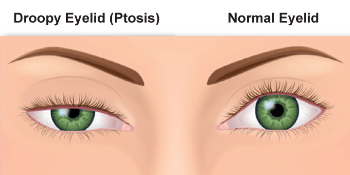 Ptosis - Symptoms, Causes and Treatment
