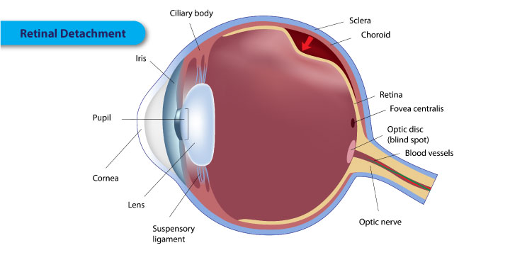 Retinal Detachment - Symptoms, Causes and Treatment