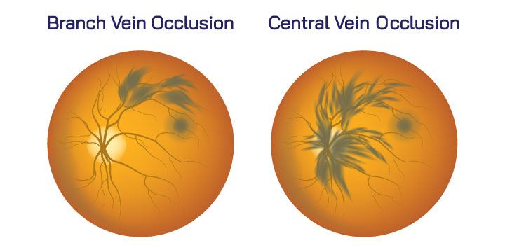 Retinal Vein Occlusion - Symptoms, Causes and Treatment