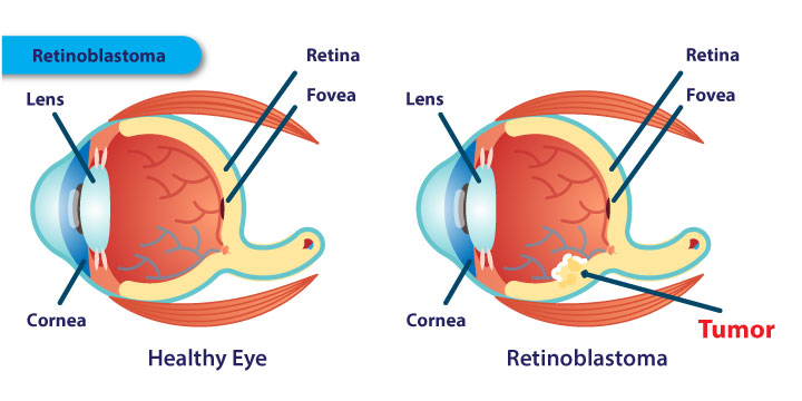 Retinoblastoma - Symptoms, Causes and Treatment