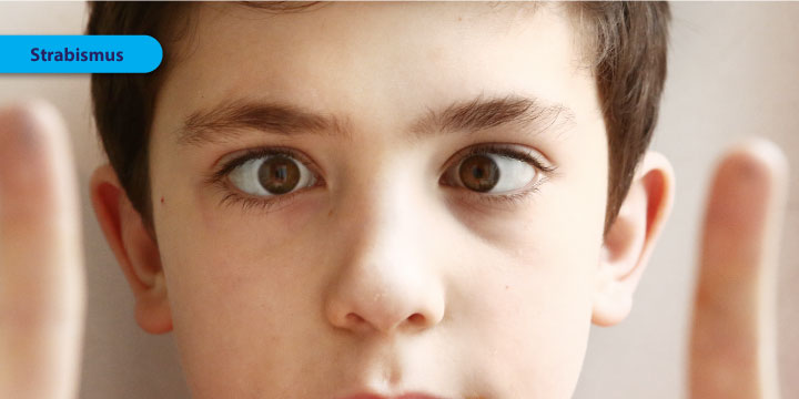 Strabismus - Symptoms, Causes and Treatment