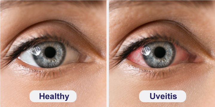 Uveitis - Symptoms, Causes and Treatment