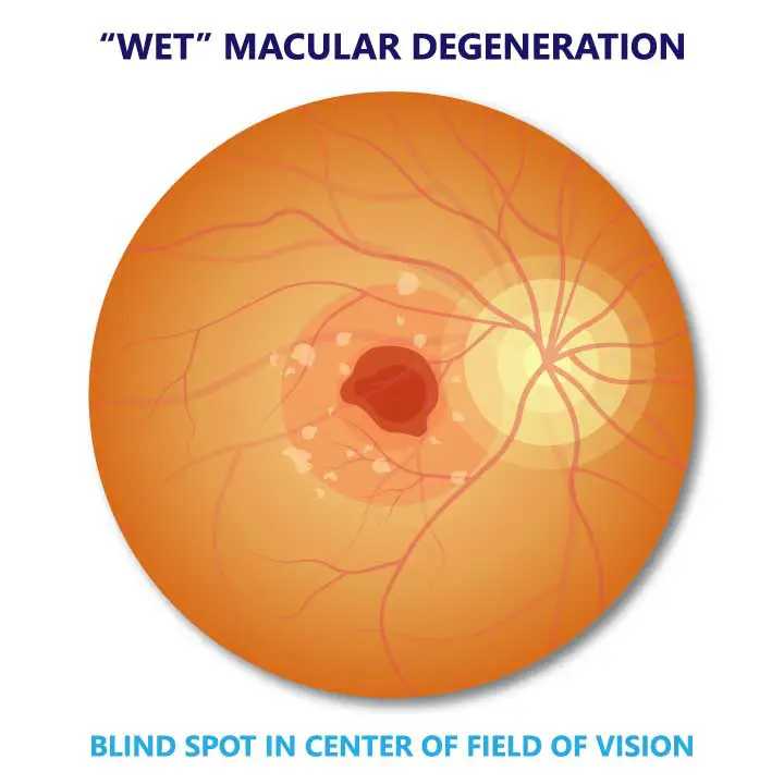 Wet Macular Degeneration